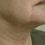Neck Liposuction Before & After Patient #151