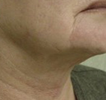 Neck Liposuction Before & After Patient #151