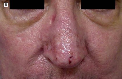 Rhinophyma Before & After Patient #157