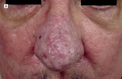 Rhinophyma Before & After Patient #157