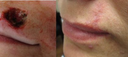 Lip Reconstruction Before & After Patient #1539