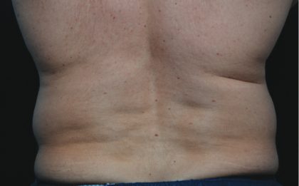 Coolsculpting Before & After Patient #1225