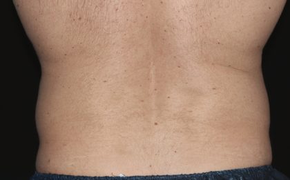 Coolsculpting Before & After Patient #1225