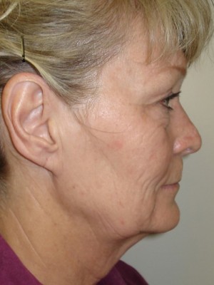 Facelift Before & After Patient #1538