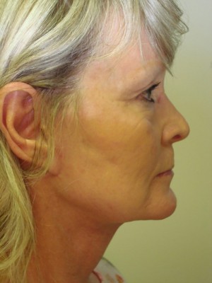 Facelift Before & After Patient #1538