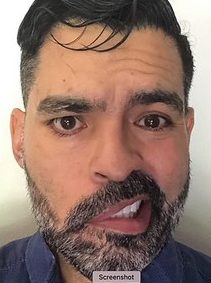 Facial Paralysis Before & After Patient #1515
